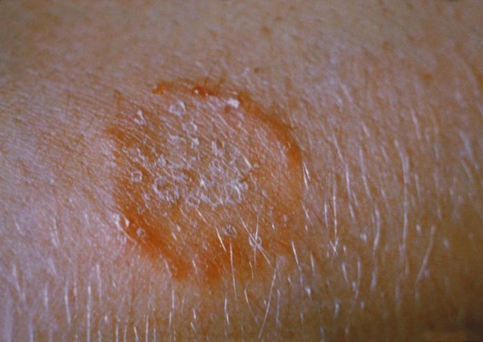 ringworm on the body